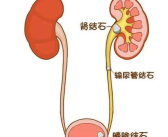 如何缓解肾结石疼痛,肾结石疼痛缓解策略全解析
